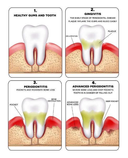 What Is Gum Disease?