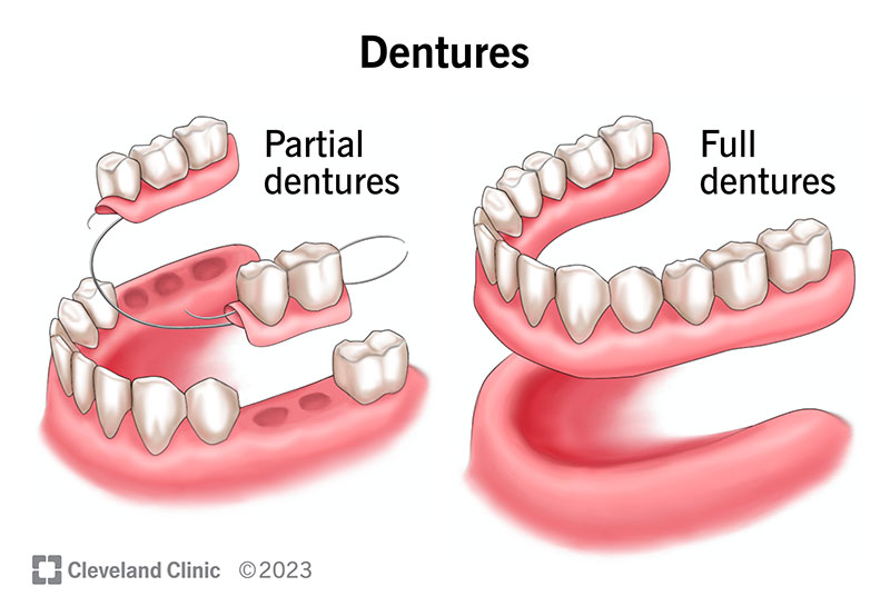 Dentures (Full or Partial)