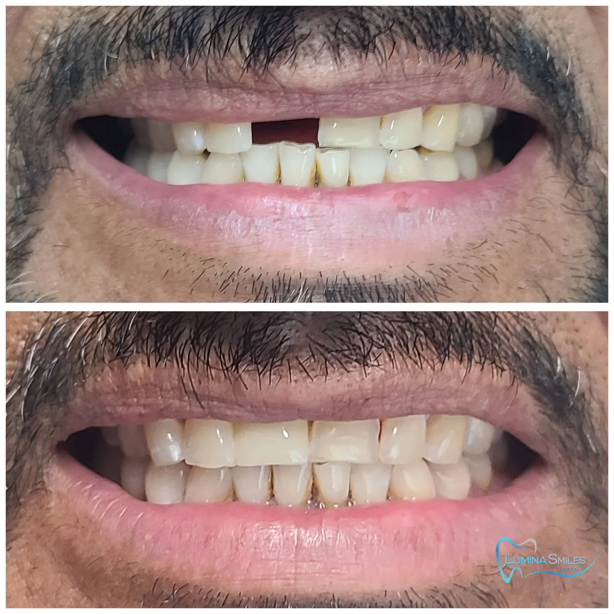 Antes y después de un puente dental Maryland realizado en Lumina Smiles Dental