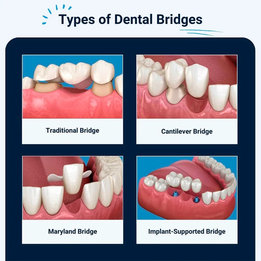 Ilustración de tipos comunes de puentes dentales